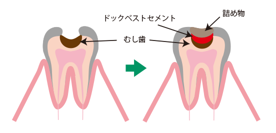 ドックベストセメント治療 | 大田区・久が原 ライラック通り歯科